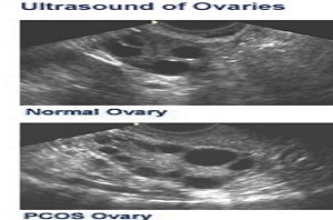 B超没有多囊，也可能是多囊卵巢综合征！