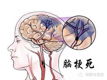 慢性脑梗塞怎么治疗最好呢,有效治疗创伤性脑梗塞的偏方