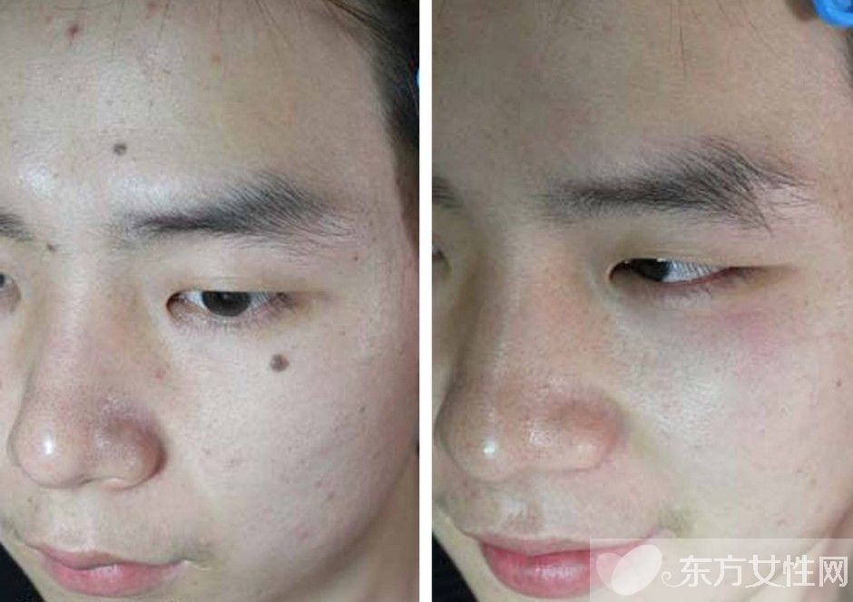 点痣后注意事项有哪些,点痣后注意事项与饮食禁忌食谱