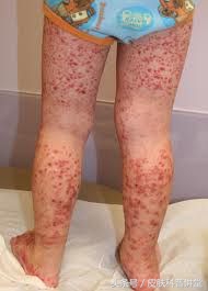 双小腿起红点不痛不痒是怎么回事,双小腿对称起红疹子痒是什么病