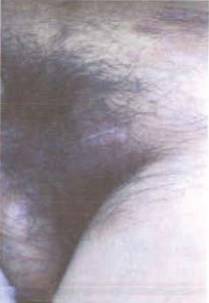 有一种病叫红斑丘疹,边界清晰发痒红斑有丘疹是湿疹吗