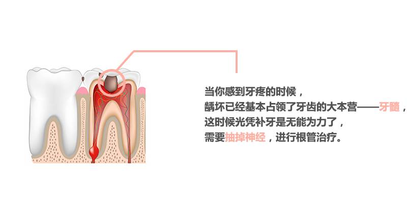 蛀牙不补怎么小洞变大了,蛀牙小洞不补大洞受罪