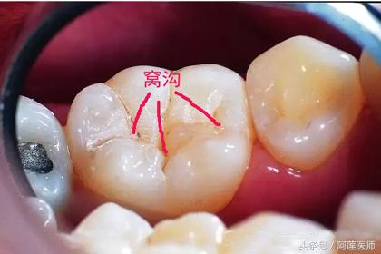 龋齿修复了又复发怎么办,龋齿处理了还疼