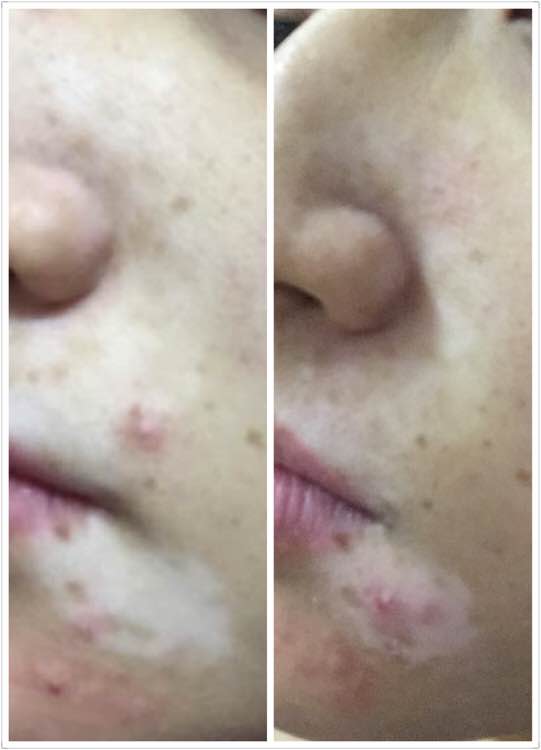 白斑光照,白斑光照后图片