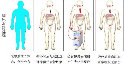 pdt光动力治疗肿瘤,肿瘤的mdt在肿瘤综合治疗中的地位