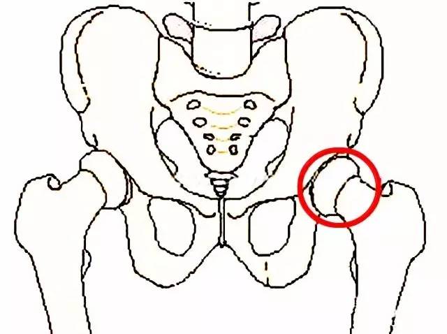 北京积水潭股骨头坏死的治疗方法,北京积水潭专家讲股骨头坏死三期