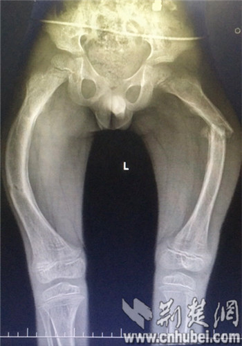 瓷娃娃骨折了31次,瓷娃娃1岁骨折
