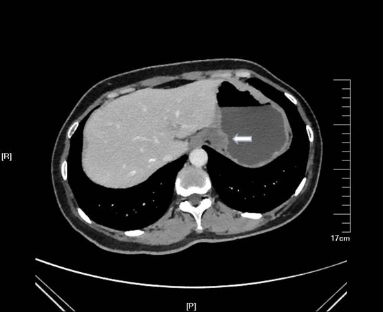 当EUS遇到“假瘤子”(二)——都是“隔壁老王”惹的祸(毗邻外压)