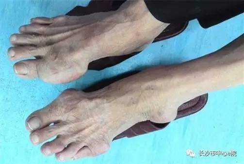 治疗类风湿关节炎的老中医推荐,治疗类风湿性关节炎最好的老中医