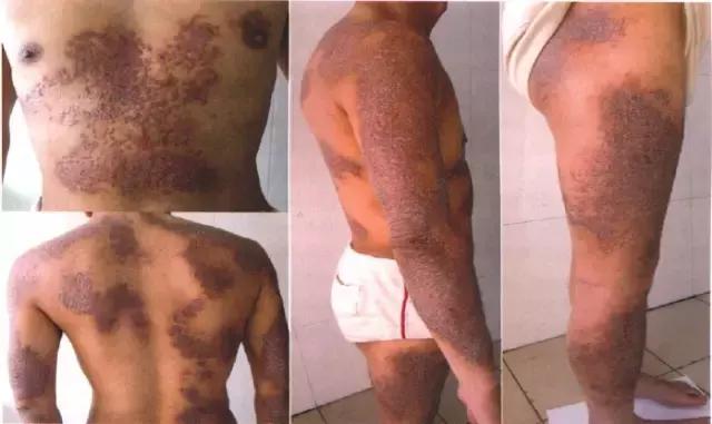 全身角化病,全身出现多处皮肤癣是什么引起的