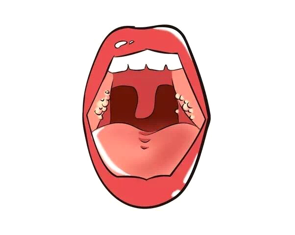 扁桃体经常发炎怎么回事,宝宝老是扁桃体化脓是怎么回事