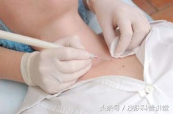 小孩传染性软疣冷冻后变成了水泡,儿童常见皮肤病疣