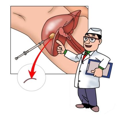 科普版脂肪肝防治指南,什么是脂肪肝症状及治疗