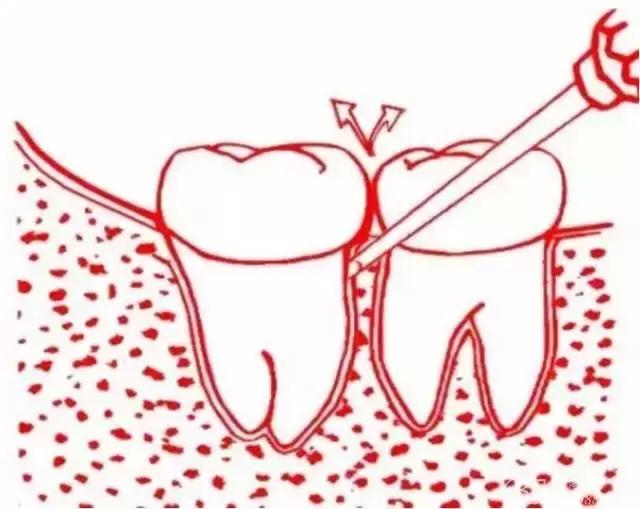 智齿的治疗过程,智齿要上下成对拔除吗