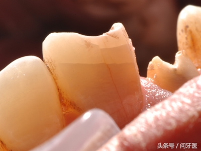 牙齿上有裂纹怎么办,牙齿上有裂纹怎么治