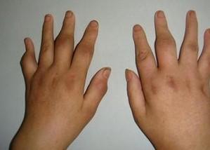 夜间盗汗只有头部出汗,夜间盗汗与棉被厚出汗有何区别