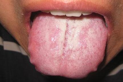 舌头反映心脏健康，淤斑、发红说明心脏有疾病了！