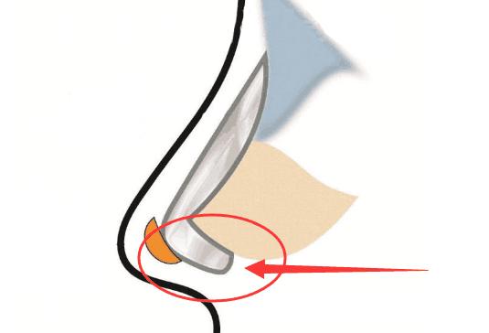 有多少人隆鼻后悔了,隆鼻的十大猫腻