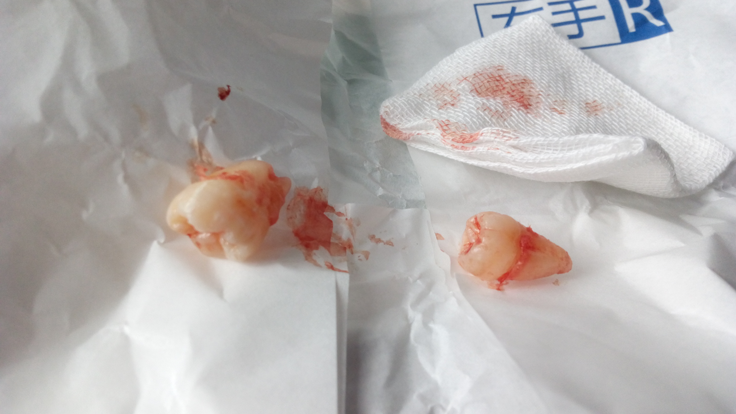 智齿微创拔牙和普通拔牙有何区别,阻生智齿一般是微创拔还是普通拔