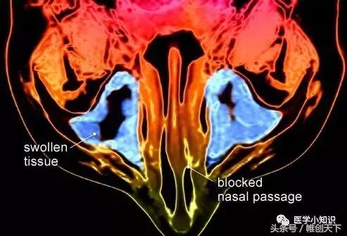 鼻窦炎临床治愈案例,鼻窦炎图片和治疗方法