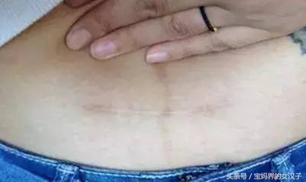 剖宫产疤痕恢复效果的好与坏，有哪些影响因素？