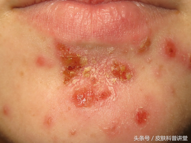 一张图教你辨别脓疱疮,皮肤科普直播