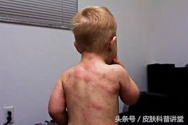 幼儿急疹的斑丘疹多久消失,幼儿急疹是否有痒的案例