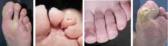 糖尿病足的预防重于治疗,糖尿病足病预防案例