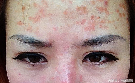 女性染发剂过敏视频,染发剂过敏眼部红肿