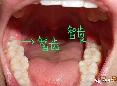 拔智齿瘦了20斤,拔完智齿变成了瓜子脸