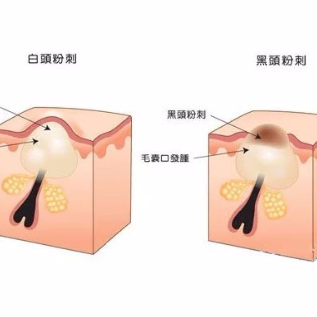 鼻子下巴闭口粉刺怎么去除,闭口粉刺护理全攻略