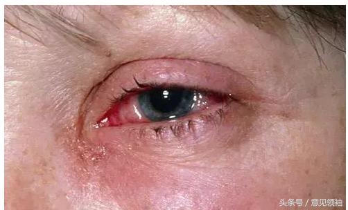 新冠红眼病有什么症状,羔羊红眼病的症状及治疗