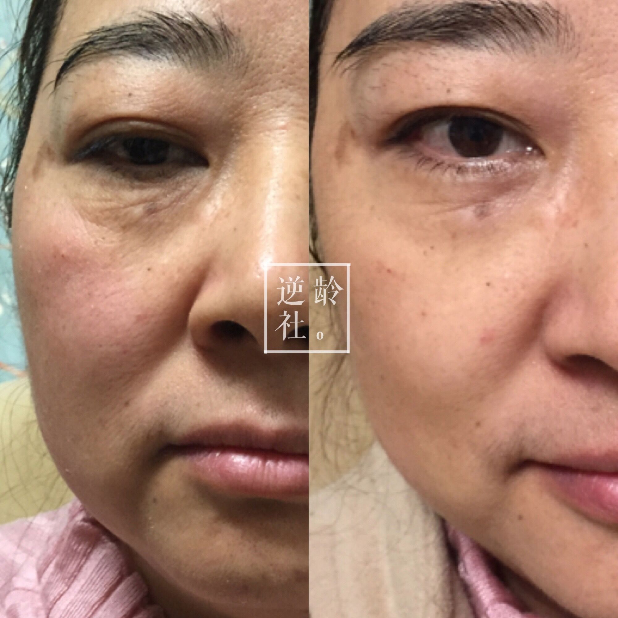 逆龄精雕好还是超声刀好,35岁做超声刀效果好吗