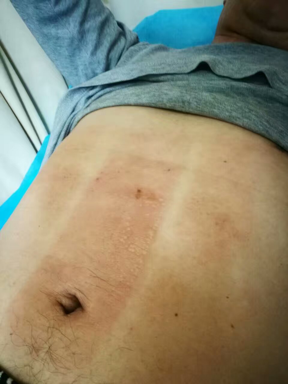 带状疱疹有没有一周痊愈的,带状疱疹一个疗程就好了吗