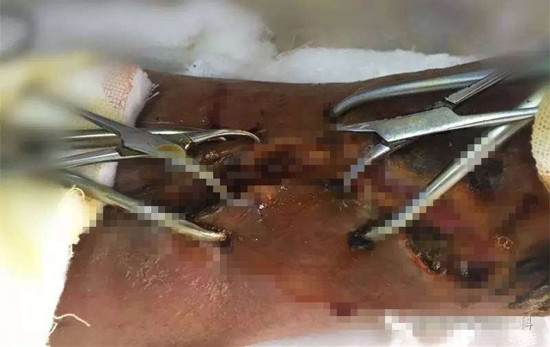 术后刀口露钢板不愈合中医疗法,术后伤口有个小洞一直不愈合