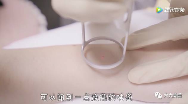 激光点痣全过程视频,激光点痣小视频
