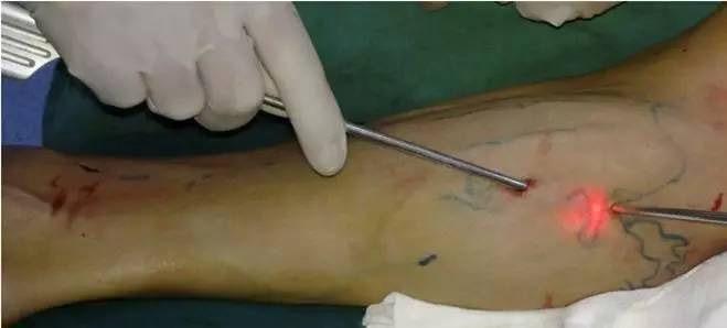 腿上青筋明显的中医辨证,怎样治愈腿上青筋