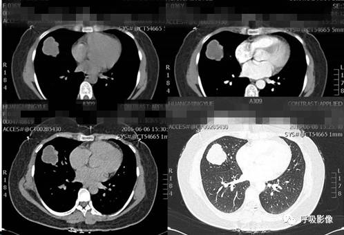 绒毛膜癌转移到脑,绒毛膜癌肺转移