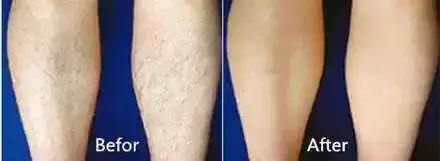 不要轻易的尝试脱毛,脱毛时大家都在做什么