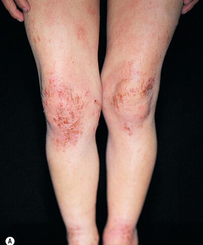 孩子湿疹最佳图片,孩子面部湿疹