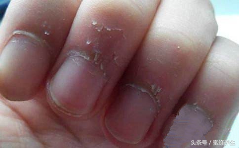 关于指甲那些不得不说的健康事儿