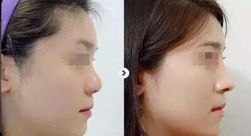 想打玻尿酸有副作用吗,想打玻尿酸怎么打