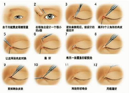 开眼角一个月还是疼,开眼角一个月还是肿需要注意什么