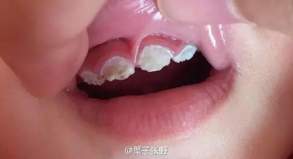 孩子的牙黑怎么办,孩子换过的牙又黄又黑