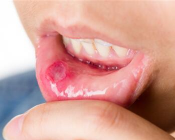 喝茶可以预防口腔癌吗,口腔癌术后怎么预防复发