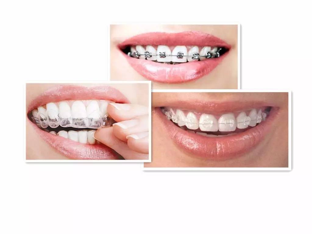隐形牙套整牙全过程介绍,拔掉四颗牙隐形牙套矫正的全过程