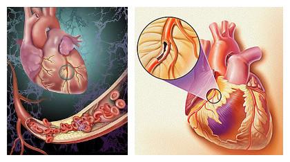 老年人心脏早搏怎么办,心脏支架后出现早搏怎么办