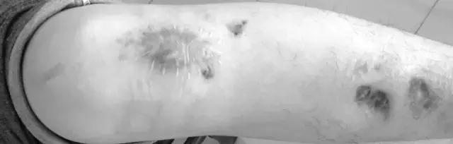 骨折内固定伤口处流脓是为什么,骨折固定支架外部流脓怎么处理