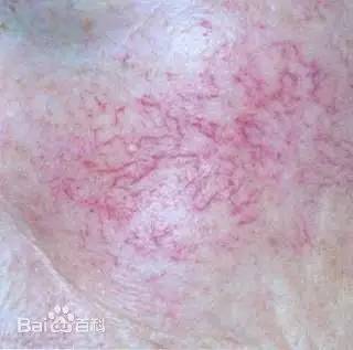 红血丝很好治的亲身经历过,我的血有一点暗红是什么原因