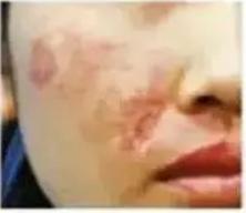 超声刀需要修复吗,超声刀失败怎样修复